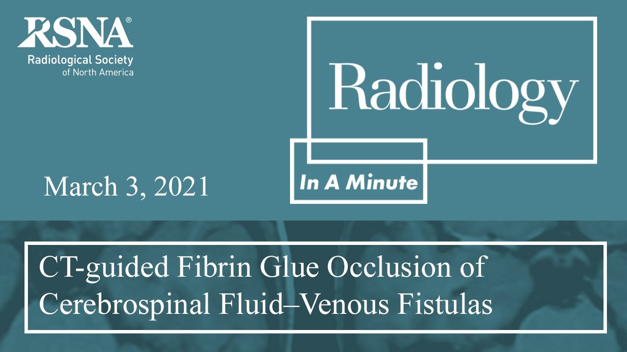 CT-guided Fibrin Glue Occlusion of Cerebrospinal Fluid&ndash;Venous Fistulas (Neuro)