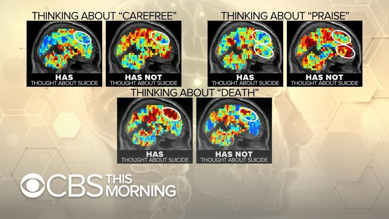 Can fMRI brain scans spot suicidal thoughts?