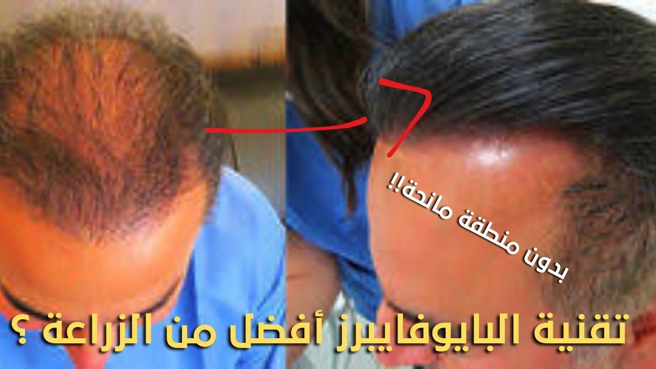 عملية زراعة شعر بدون منطقة مانحة؟