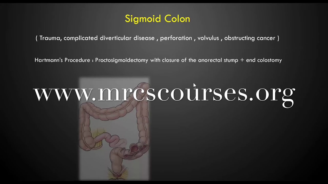 Hartmann&rsquo;s Procedure in One Minute   