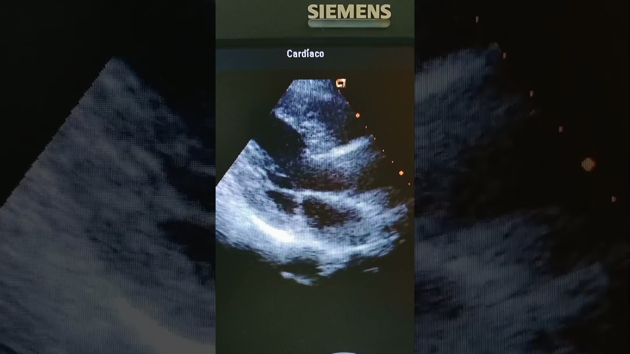 Cardiopat&iacute;a Hipertensiva #saludcardiaca #enfermedadescardiovasculares #doctor