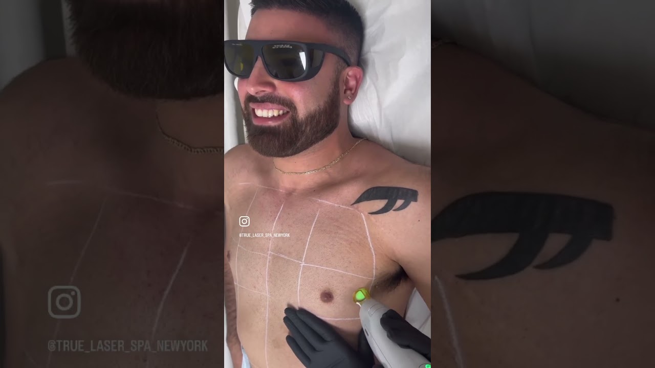 Laser Hair Removal by Candela Gentle max pro