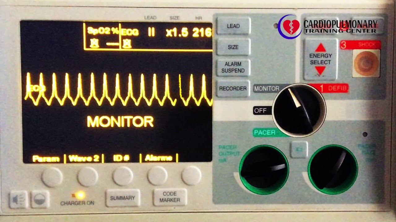 Taquicardia Supraventricular