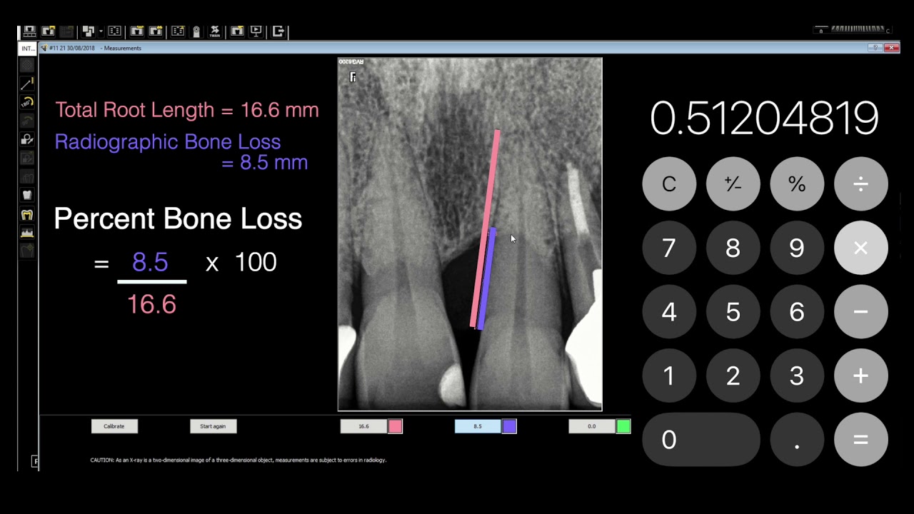 Periodontitis Percent Root Bone Loss