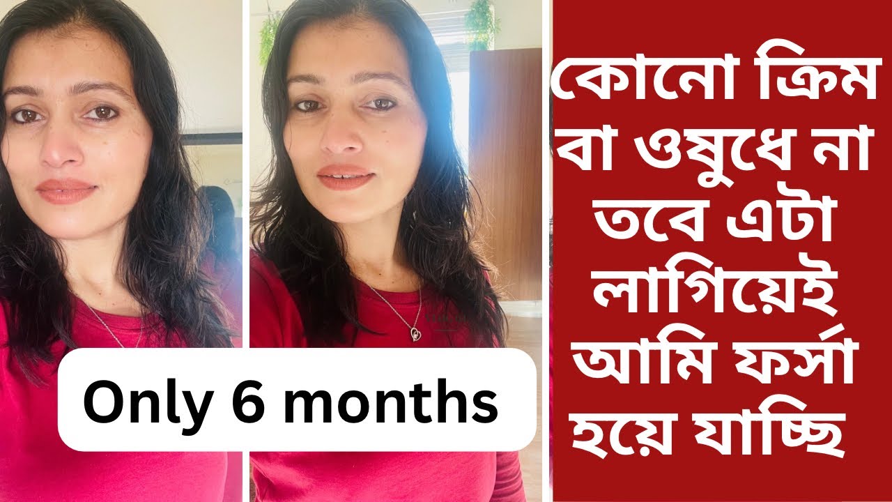 কোনো ক্রিম বা ওষুধ না এটা লাগান আর 6 মাস পর রিজাল্ট বলবেন #england 