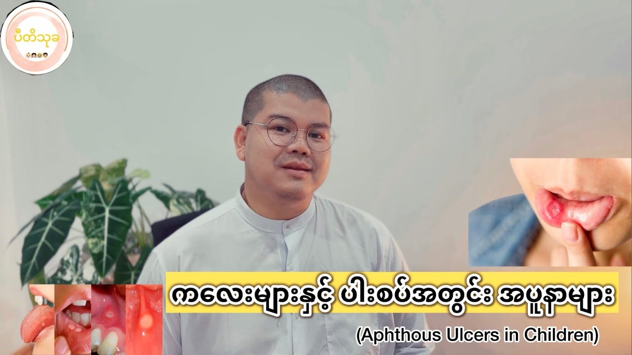 ကလေးများနှင့် ပါးစပ်အတွင်း အပူနာများ(Aphthous Ulcers in Children)