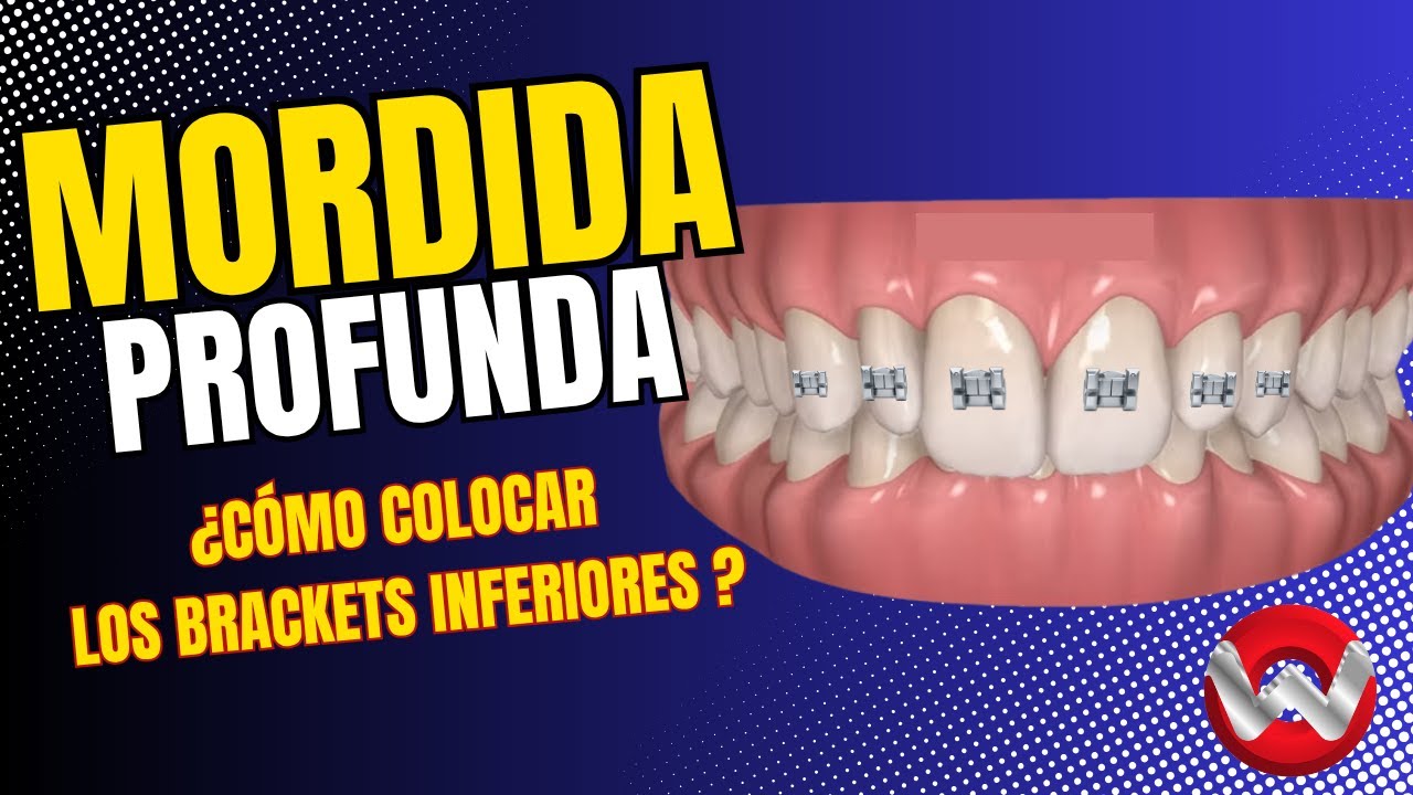 🛠️ Mordida profunda: ¿Cómo hago espacio para los brackets inferiores? 🦷