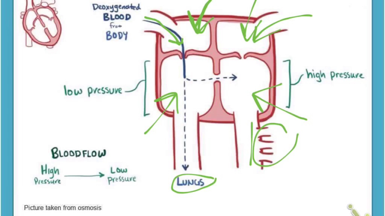 Left to right shunt (ventricular septal defect)
