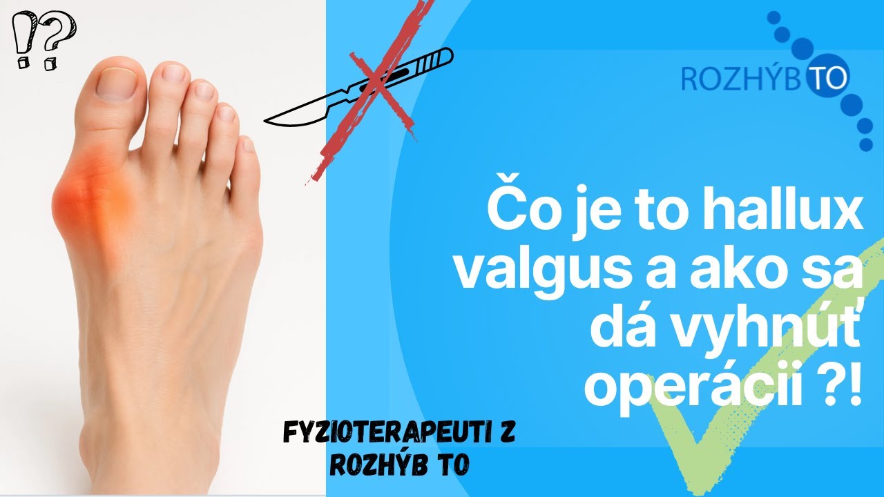 🤔 Čo je to halux valgus ? + cviky