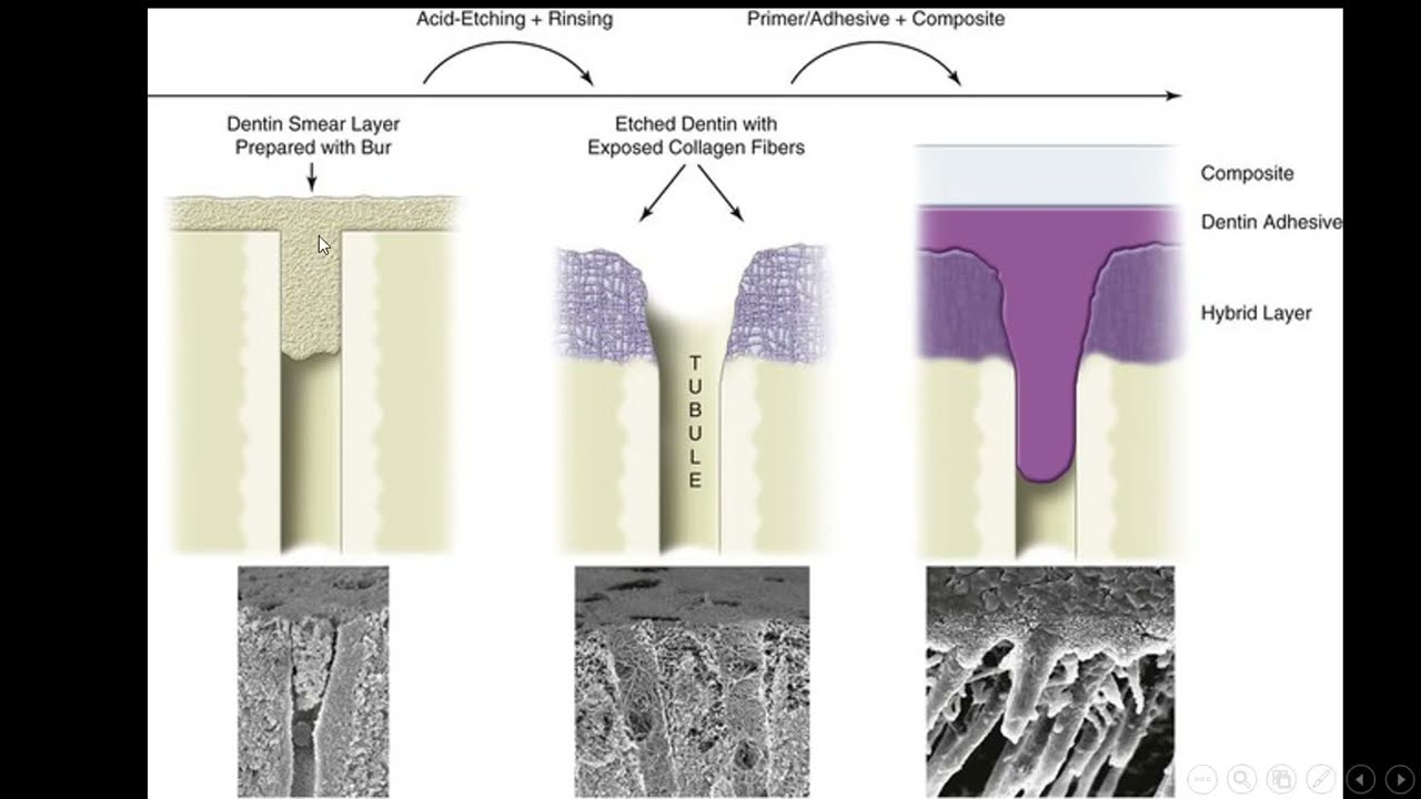 Dental Adhesive system