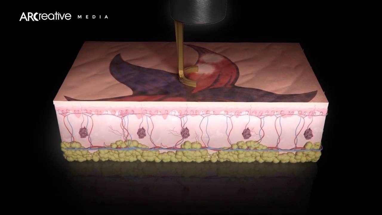 Tattoo Removal - Picoway Resolve Teaser (3D Medical Device Animation)