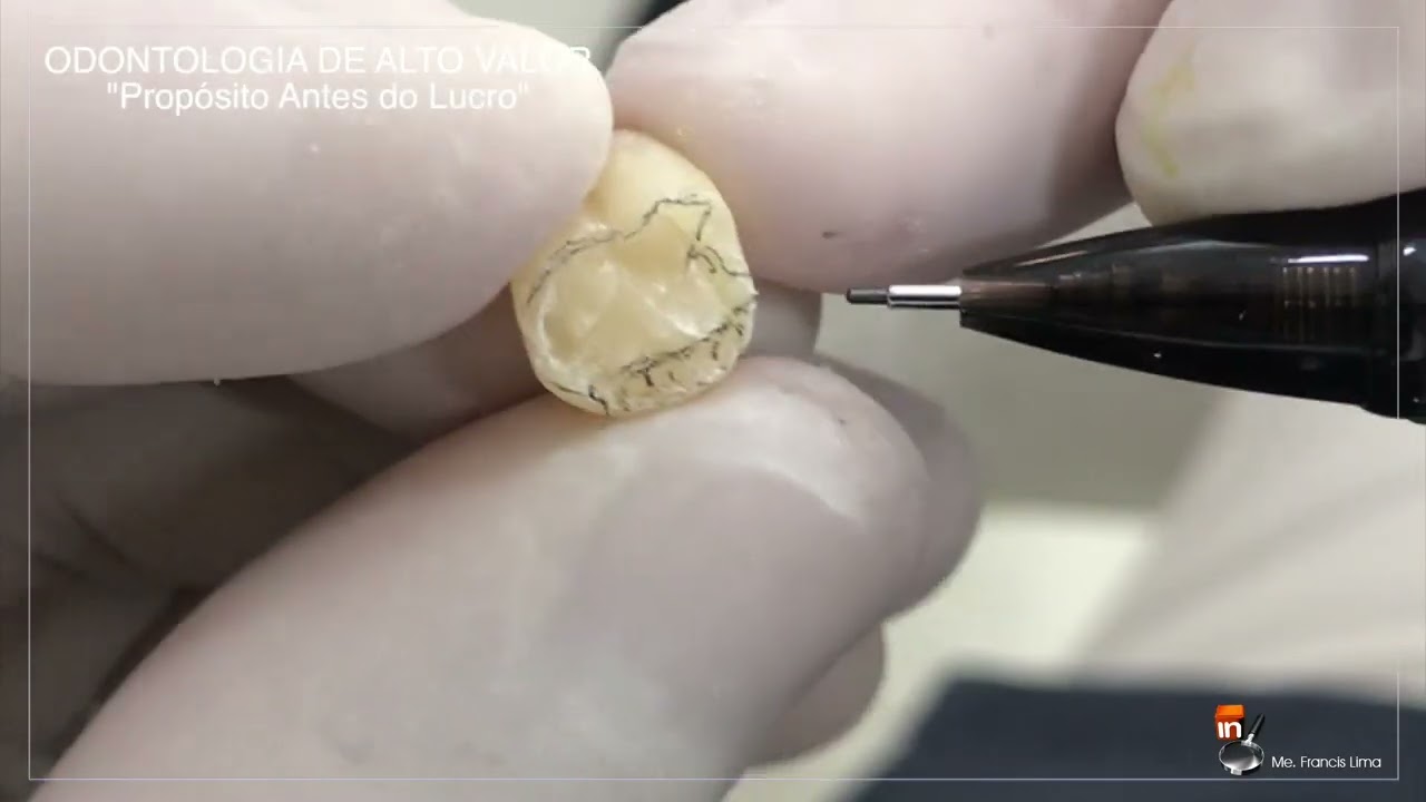 PROVISÓRIO UNITÁRIO - PRIMEIRO MOLAR SUPERIOR - TÉCNICA DA RESINA ACRÍLICA ESCULPIDA