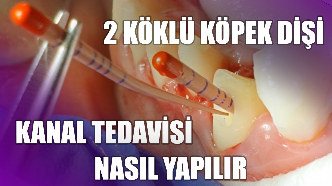2 K&ouml;kl&uuml; K&ouml;pek Dişi !!! Kanal Tedavisi Nedir? Kanal Tedavisi Nasıl Yapılır?