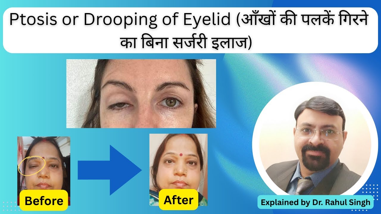 Ptosis | Drooping of Eyelid (आँखों की पलकें गिरने का बिना सर्जरी इलाज) | Ptosis Homeopathy Treatment