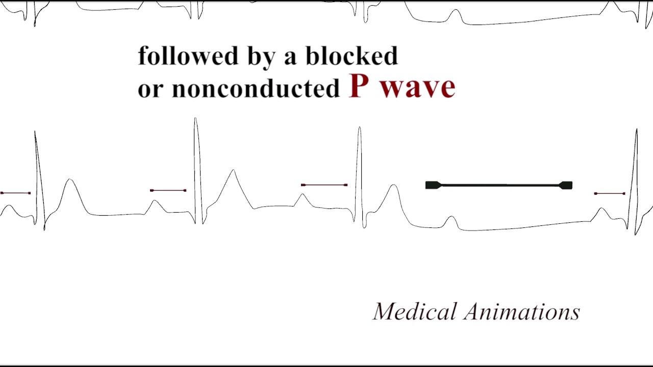 mobitz 1 vs  mobitz 2. what is the difference between mobitz 1 and mobitz 2