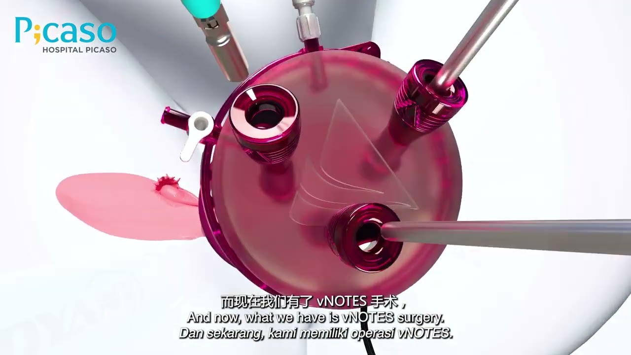 vNOTES Scarless Surgery