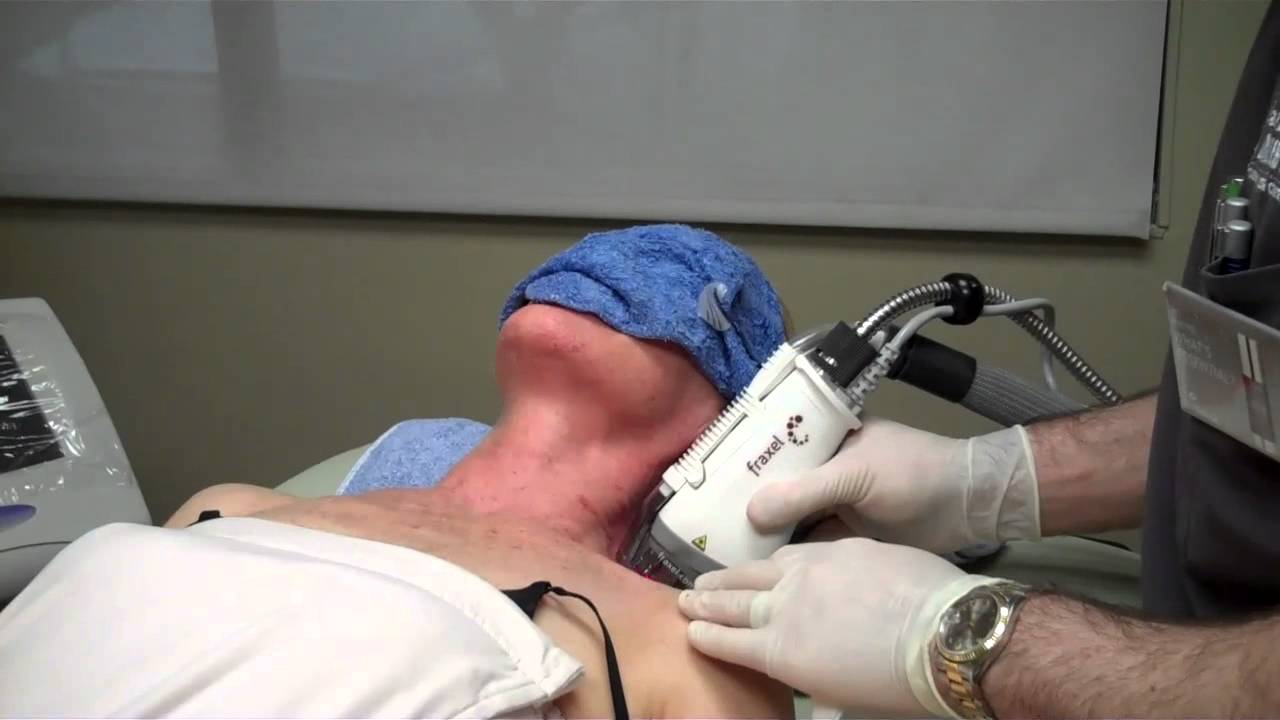 Fraxel Dual Laser on Female Chest by Dr. Seiler