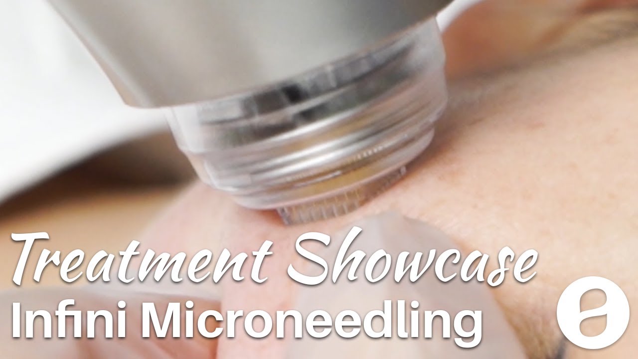 Infini RF Microneedling - Treatment Showcase
