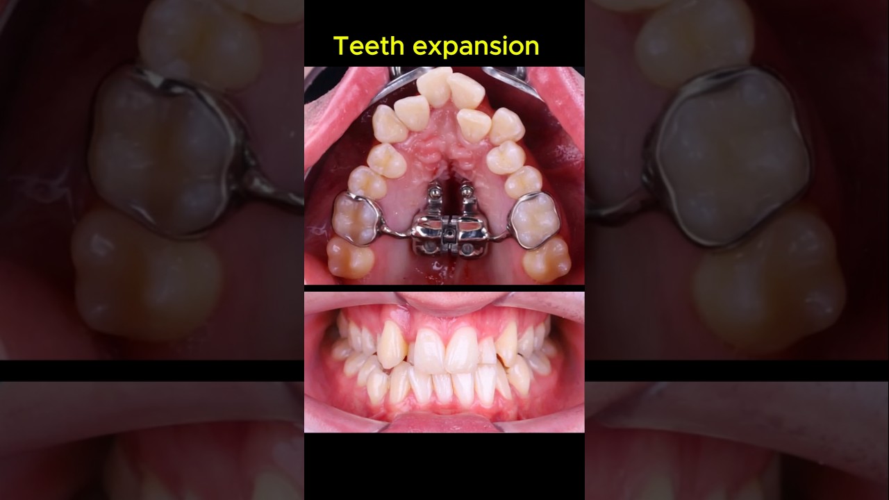 Why do need expansion jaw before braces? #dentist #orthodontist #braces