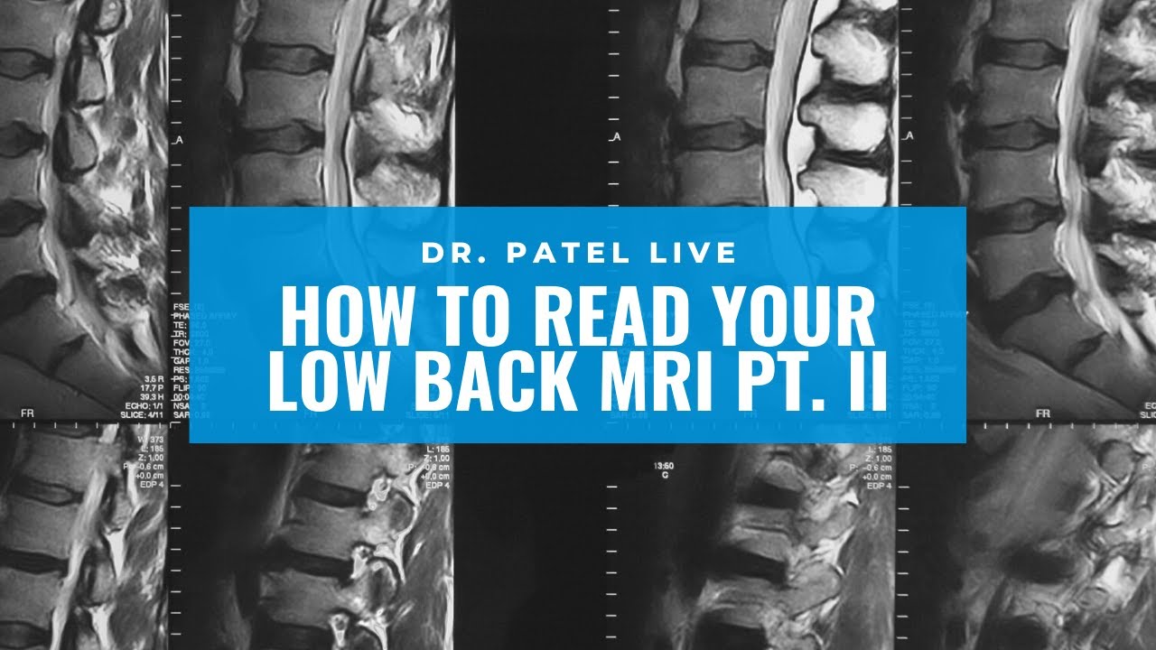Dr. Patel LIVE: Low Back MRI Tutorial Part II