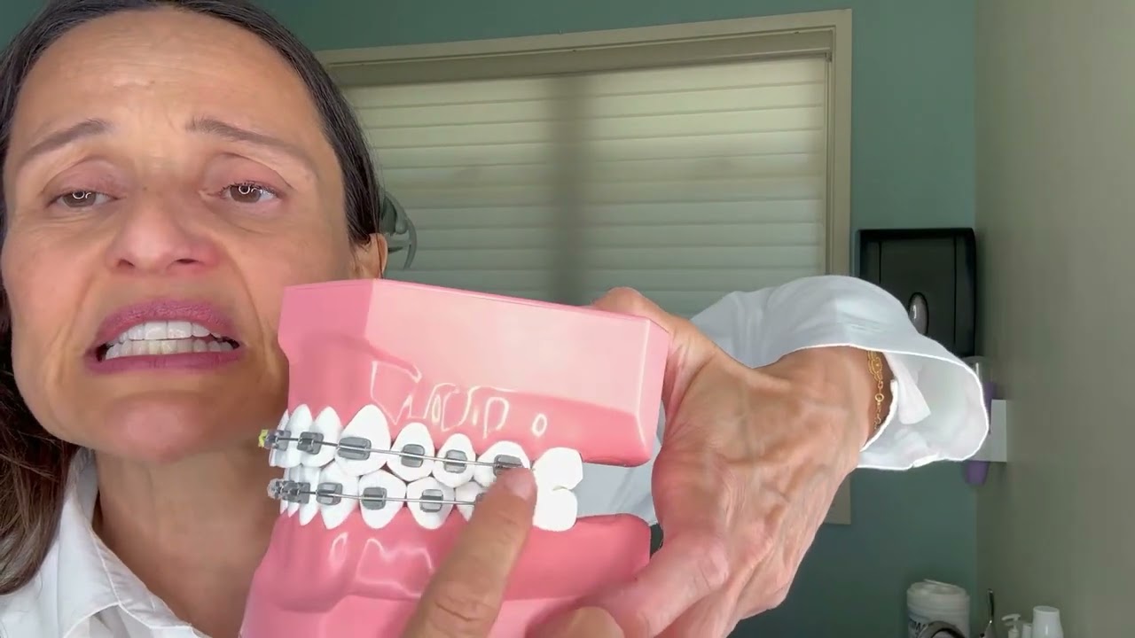 Traditional Braces - Orinda Dentist Dr. Ellis