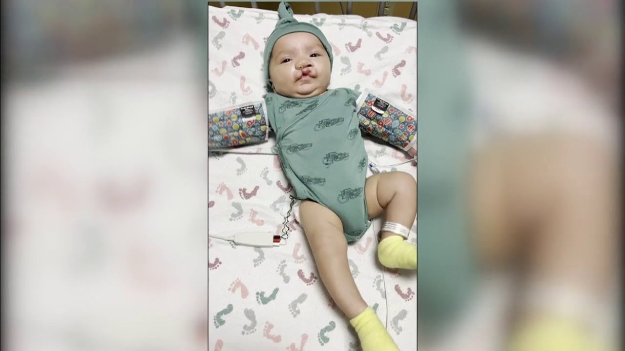 1 in 1,600 babies in US born each year with cleft lip, palate