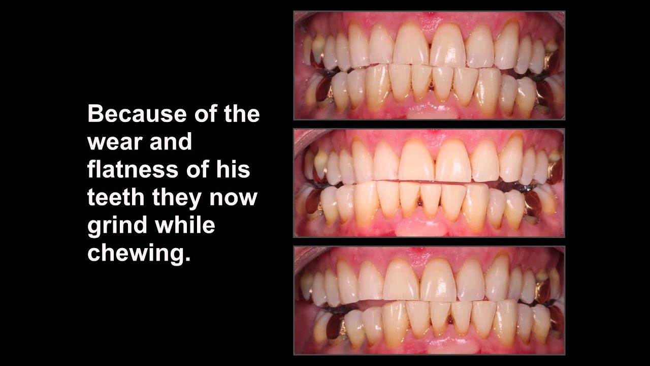 Cosmetic Bonding: Bert