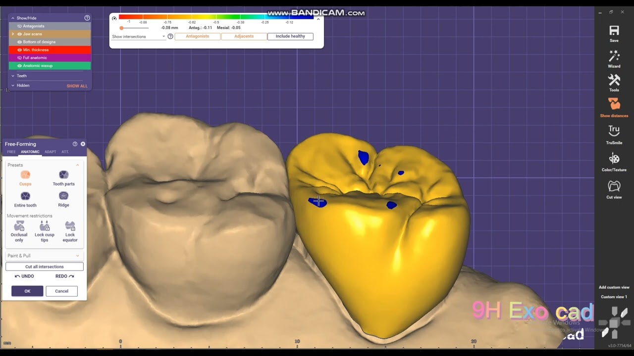 Exocad design oral scan model