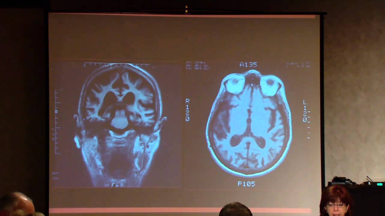 Treatment of and Research on Corticobasal Syndrome/Degeneration (CBS/CBD)