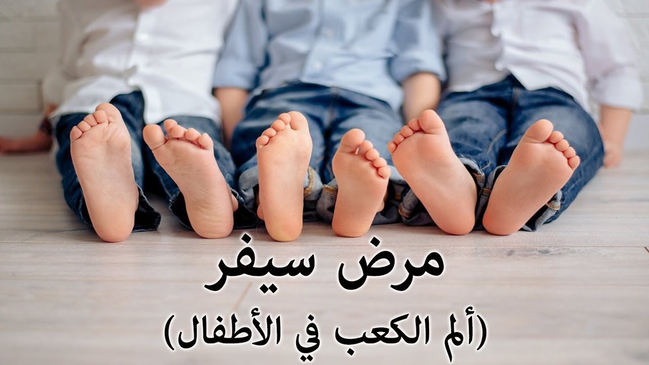 الم الكعب فى الأطفال (مرض سيفر ) - Sever's disease