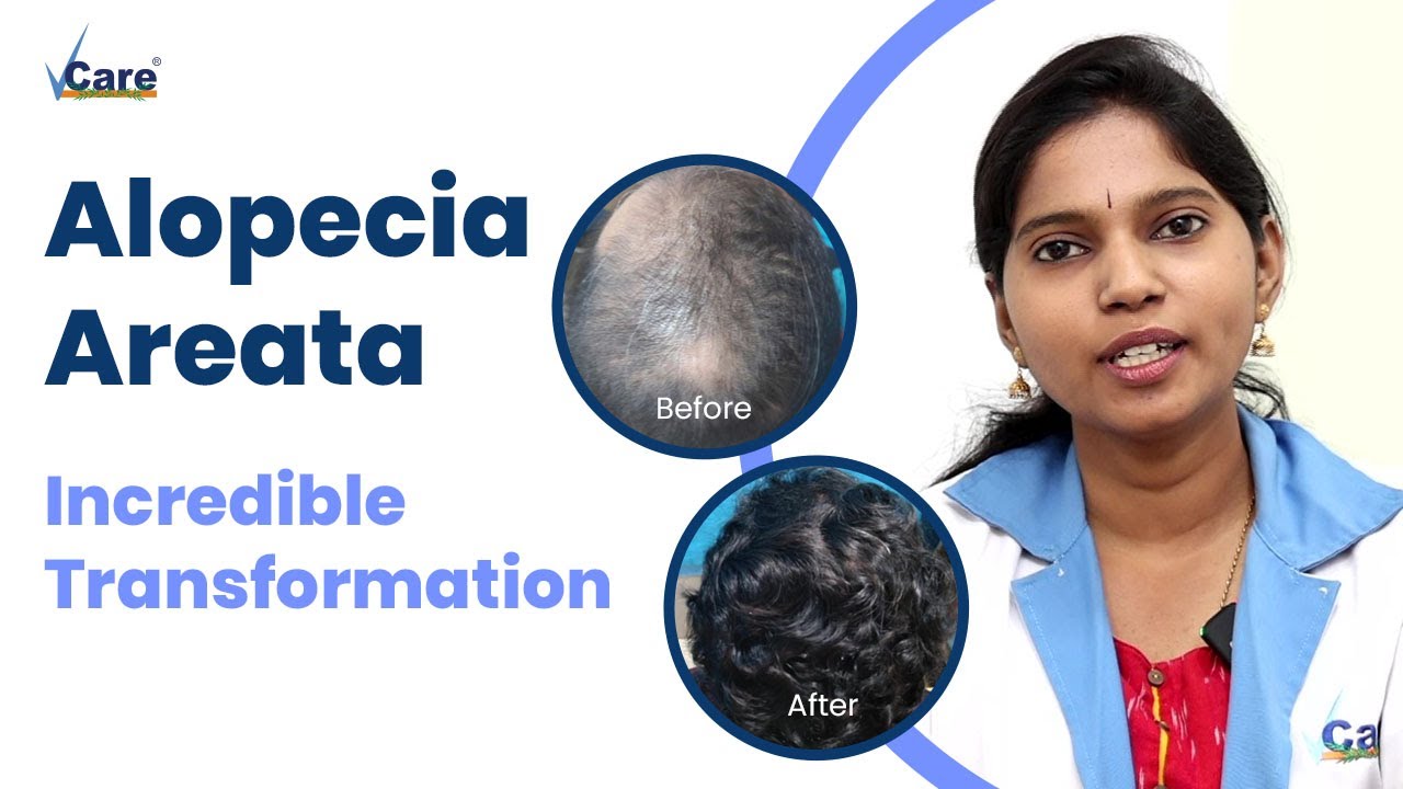 Alopecia Areata | How We Restored Hair Growth? Amazing Transformation With Alopecia Treatment Kit