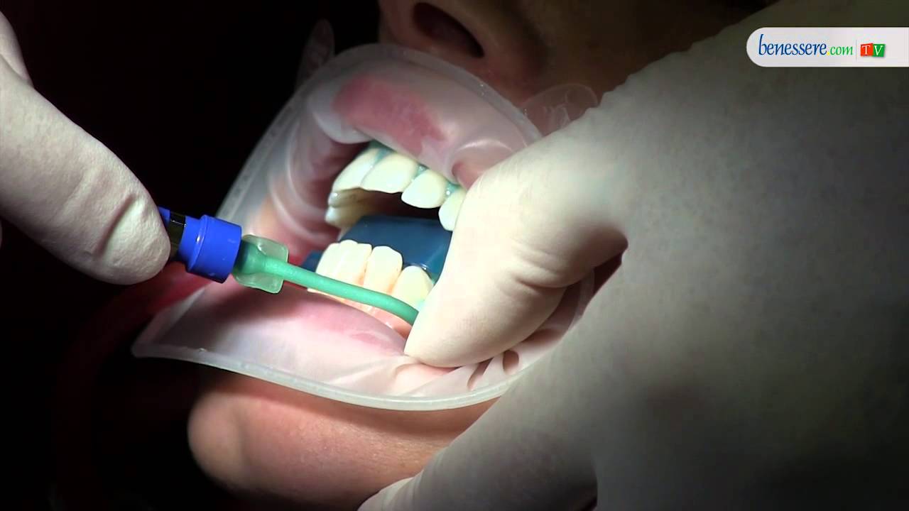 Sbiancamento dentale, i consigli dell'esperto