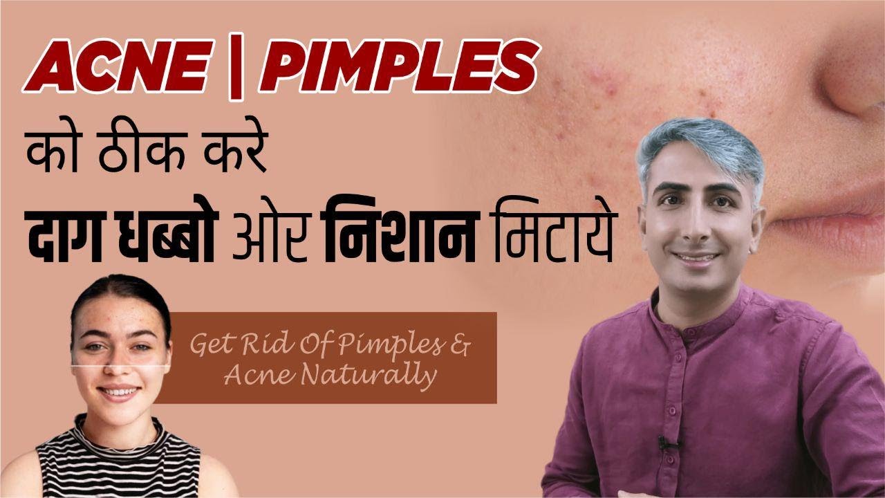 ACNE SCARS I PIMPLES को ठीक करे , दाग धब्बो ओर निशान मिटाये I GET RID OF PIMPLES AND ACNE MARKS I