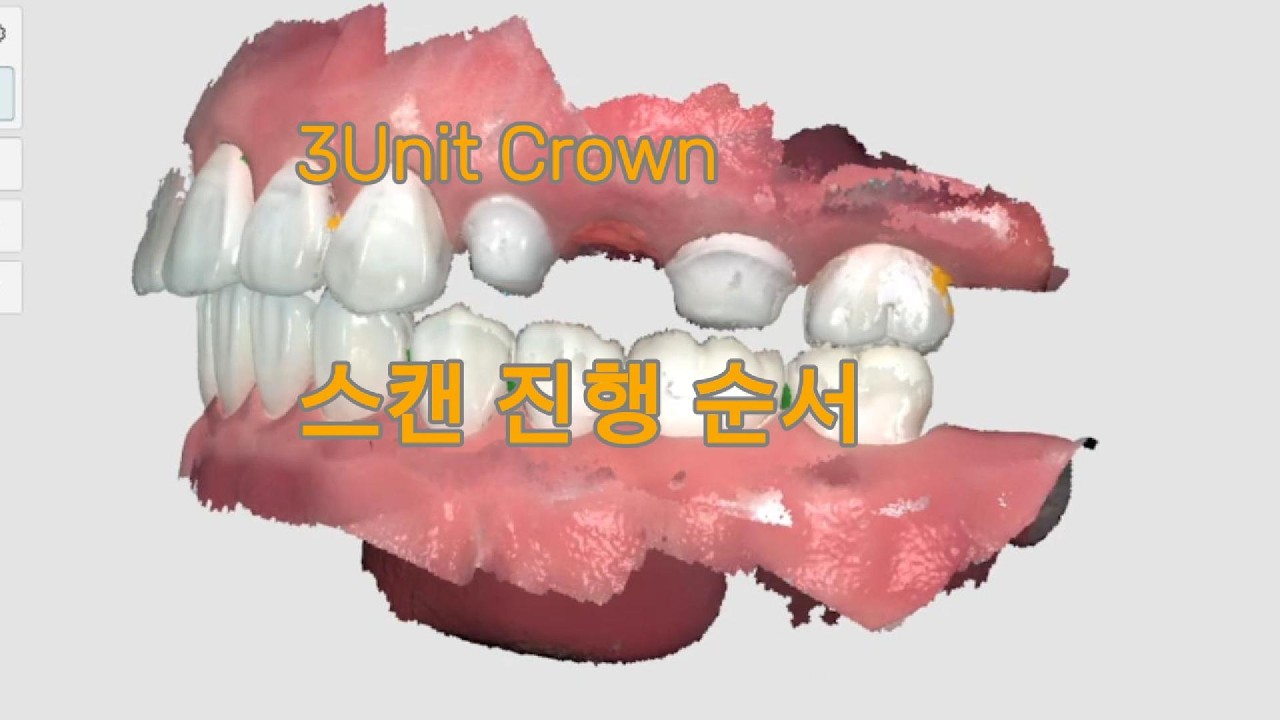 3Unit Crown 스캔 진행 순서