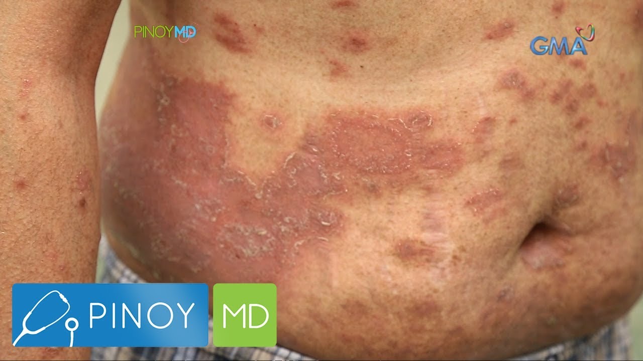 Pinoy MD: Ano nga ba ang Psoriasis?