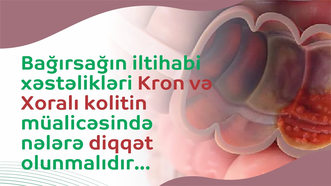 Bağırsağın iltihabi xəstəlikləri  #Kron və Xoralı #kolitin müalicəsində nələrə diqqət olunmalıdır...