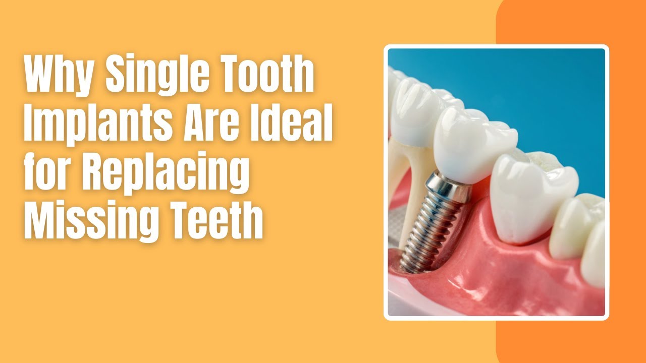 Why Single Tooth Implants Are Ideal for Replacing Missing Teeth | Shrouf Dental House