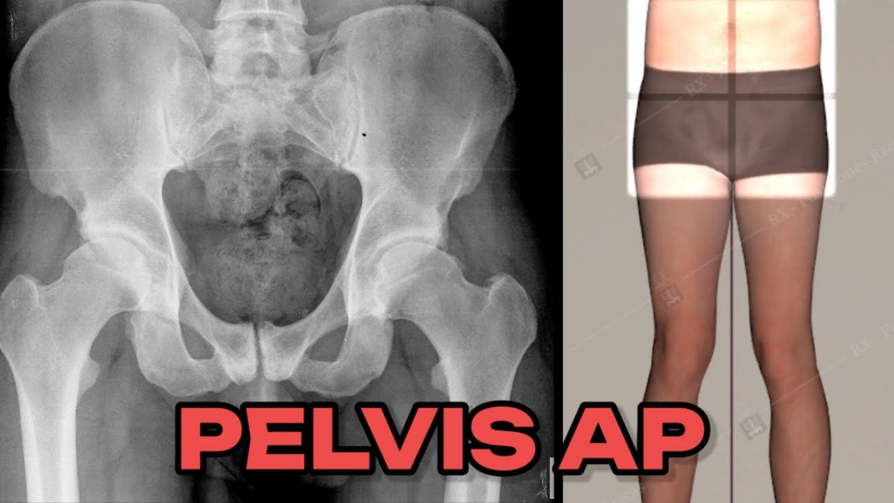 RADIOGRAFÍA DE PELVIS AP (MANUAL DE BOLSILLO) #5