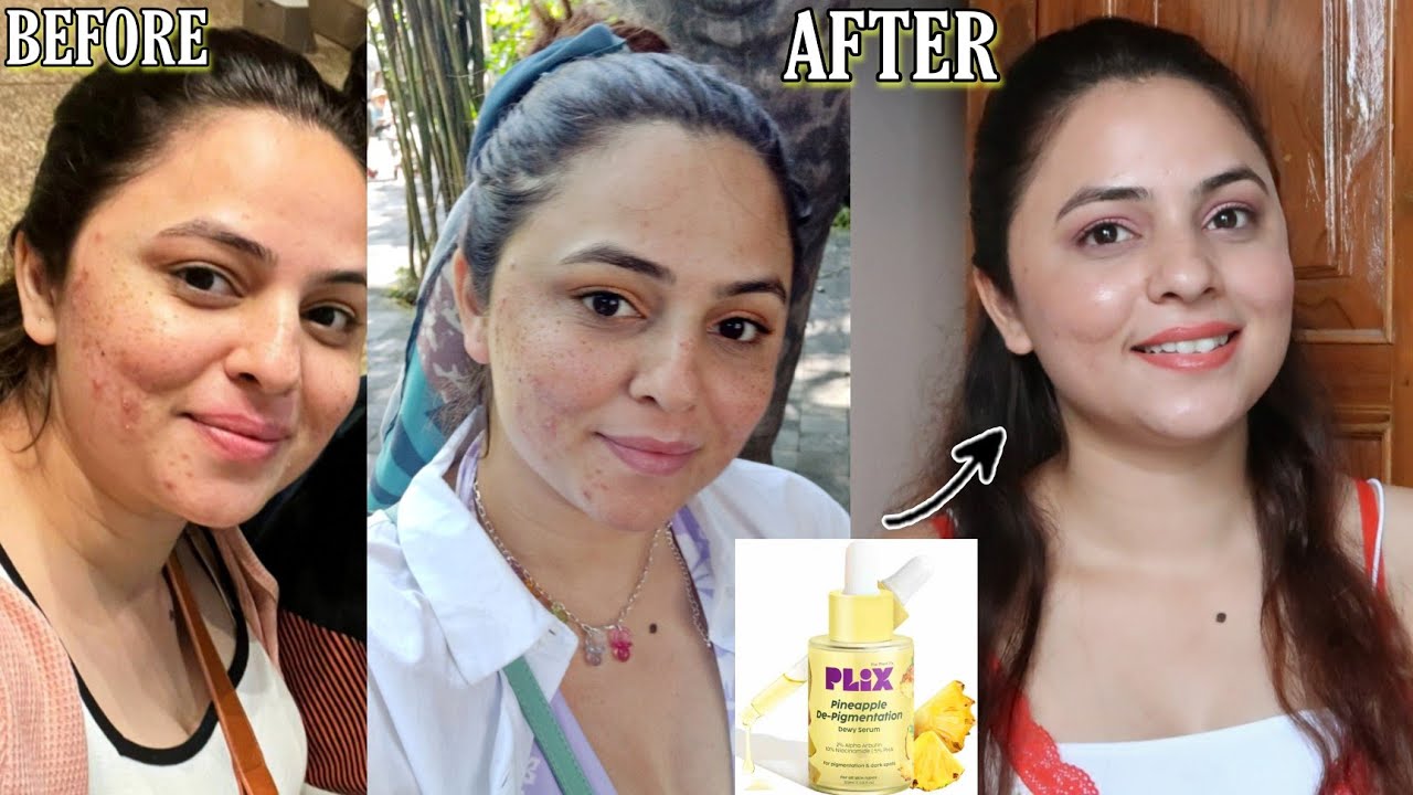 How I Reduced My Pigmentation in 90 days with PLIX Pineapple De-pigmentation Dewy Serum