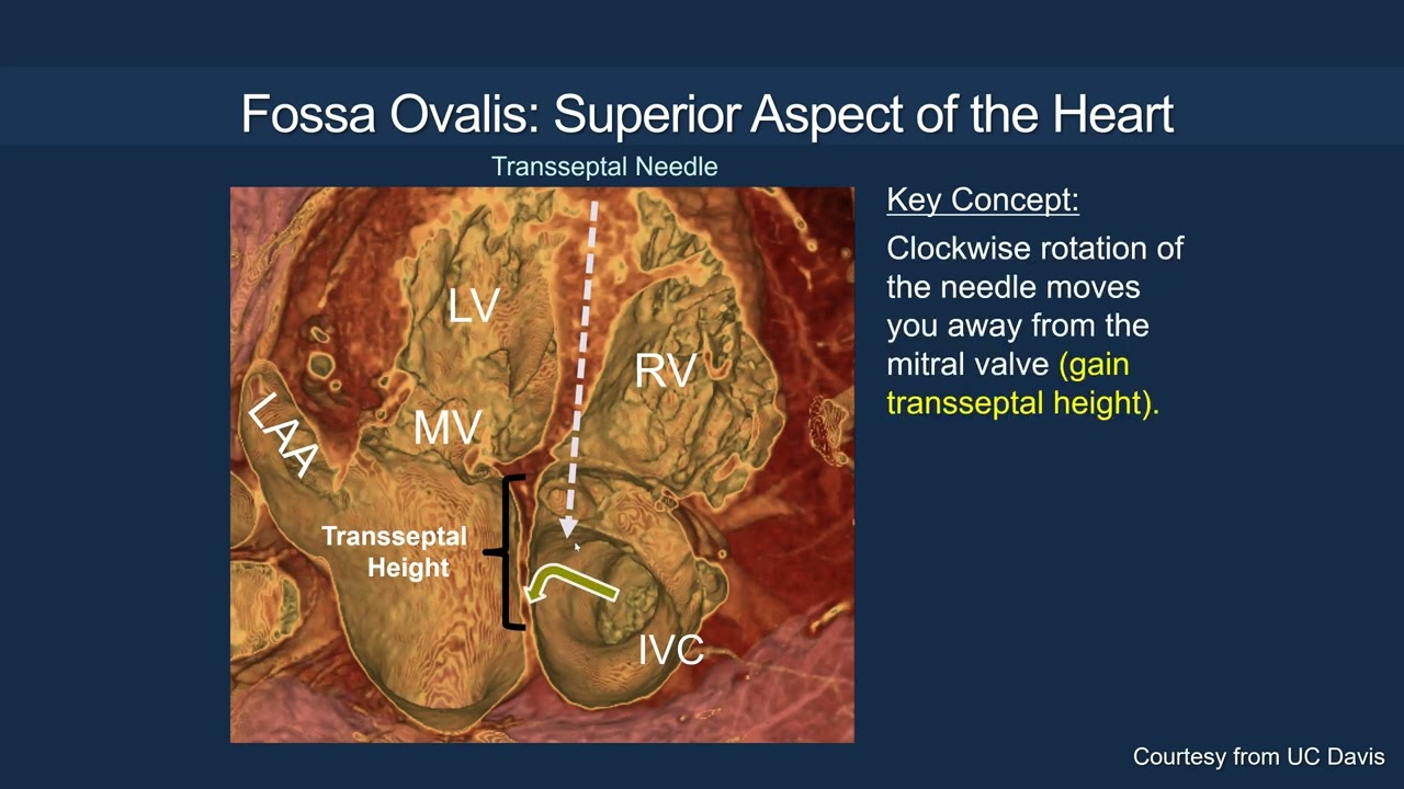 Transseptal Access Fundamentals