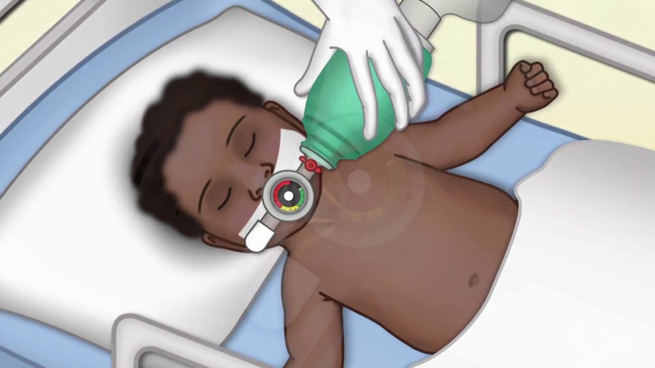 Настройка аппарата ИВЛ от Н. Макгоуэна | OPENPediatrics