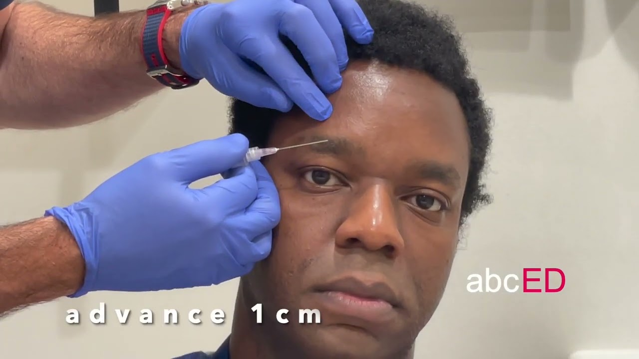 forehead nerve blocks