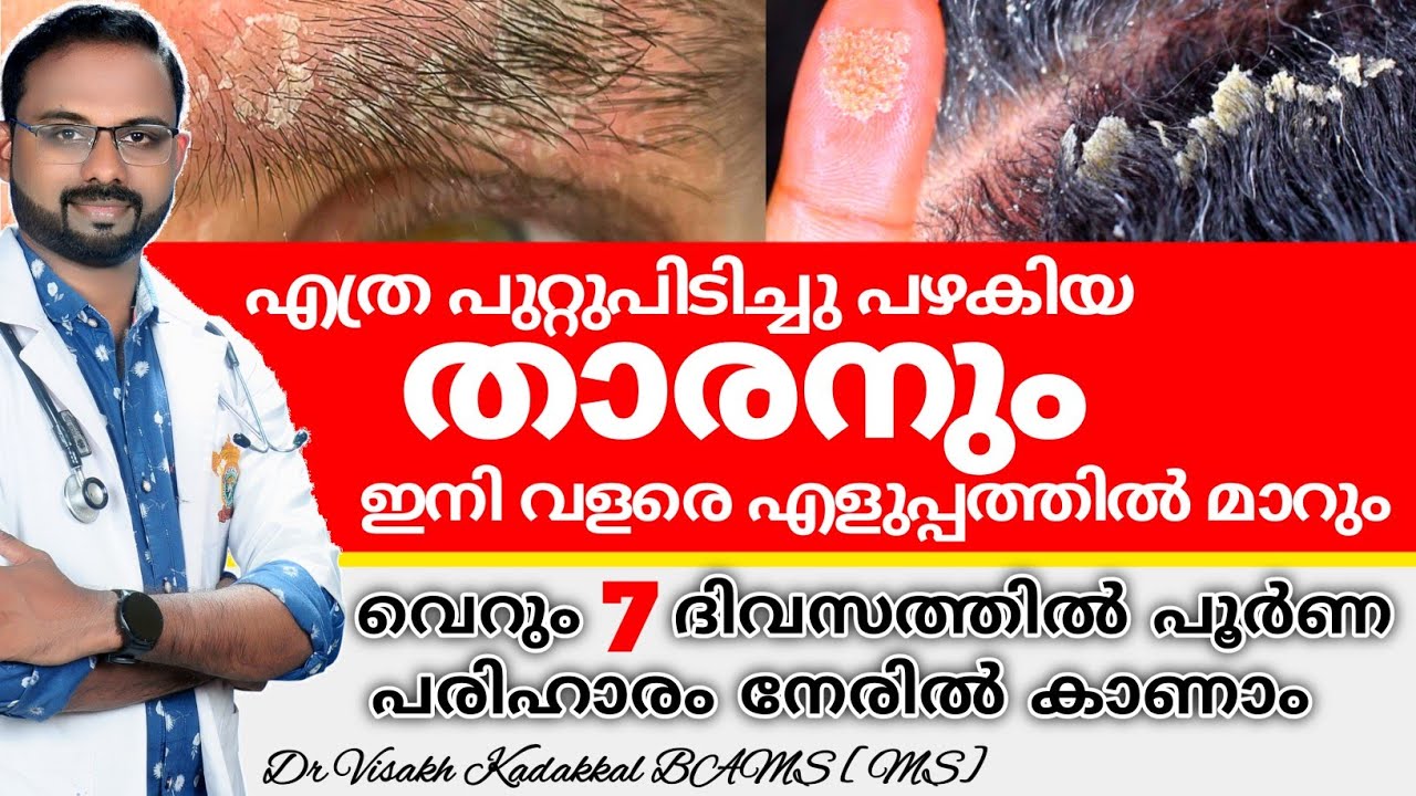 താരൻ പൂർണമായും മാറാൻ | Best Dandruff Removal Treatment at Home | Dr Visakh Kadakkal
