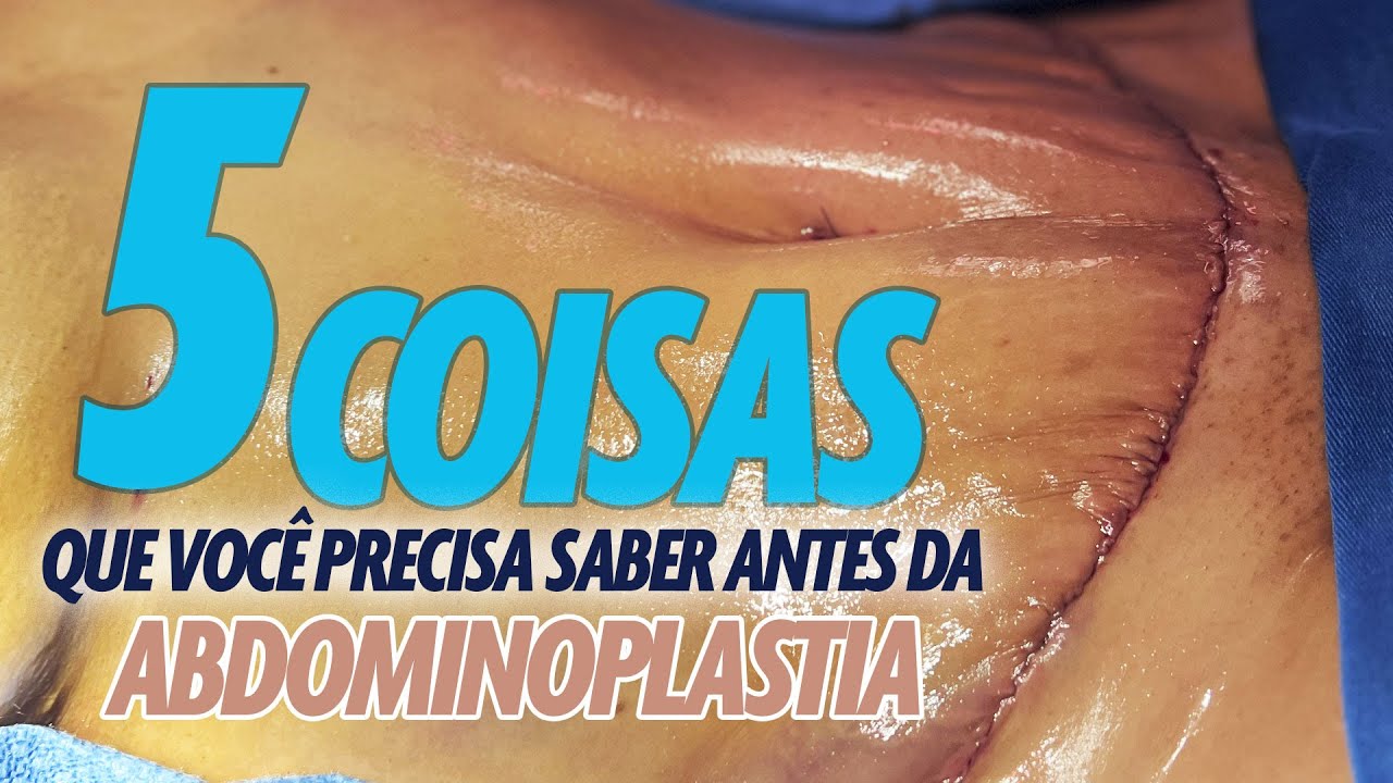 5 COISAS QUE VOCÊ PRECISA SABER ANTES DE FAZER ABDOMINOPLASTIA? CIRURGIA PLASTICA