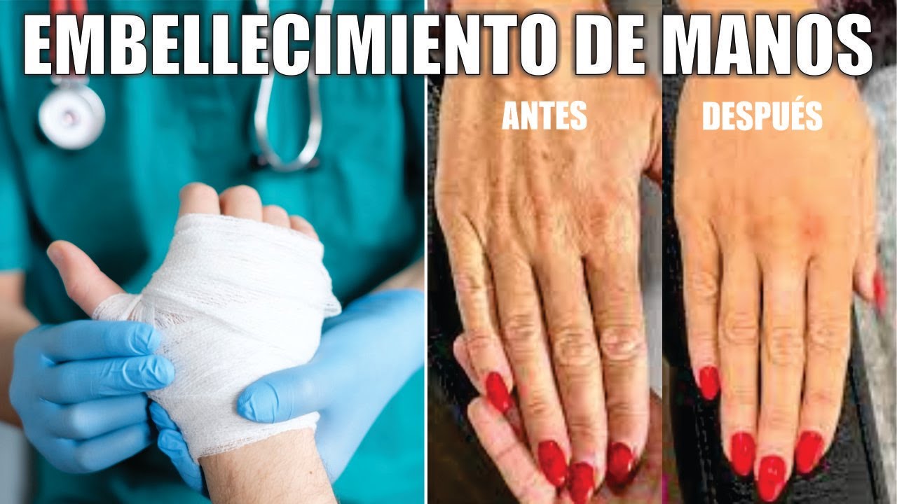 EMBELLECIMIENTO DE MANOSR 🤚 Láser, Lipotransferencia y ácido hialurónico en MANOS 🤲 Dr ALBERTO CALVO