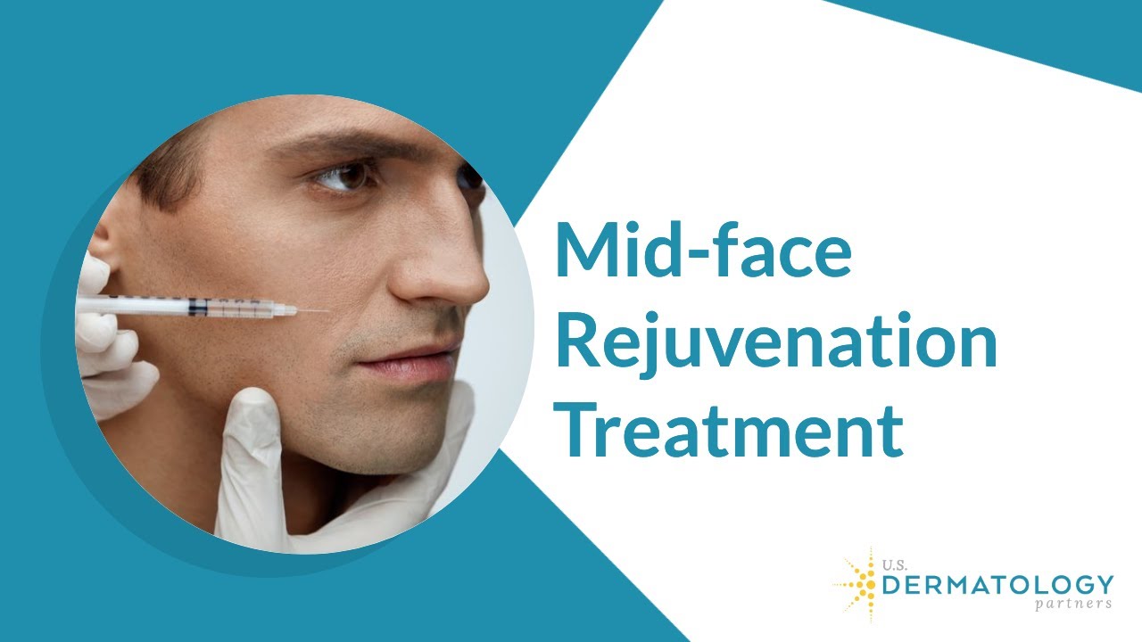 Midface Dermal Filler Treatment