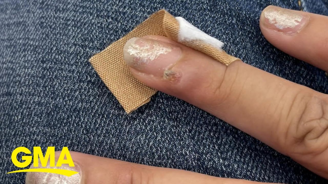 Woman claims she got HPV-related nail cancer after salon visit l GMA