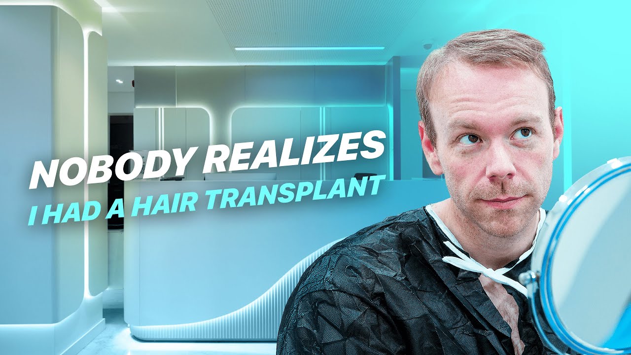 I Got a Hair Transplant... But No One Noticed! #hairtransplantturkey #sapphirefue #3000grafts