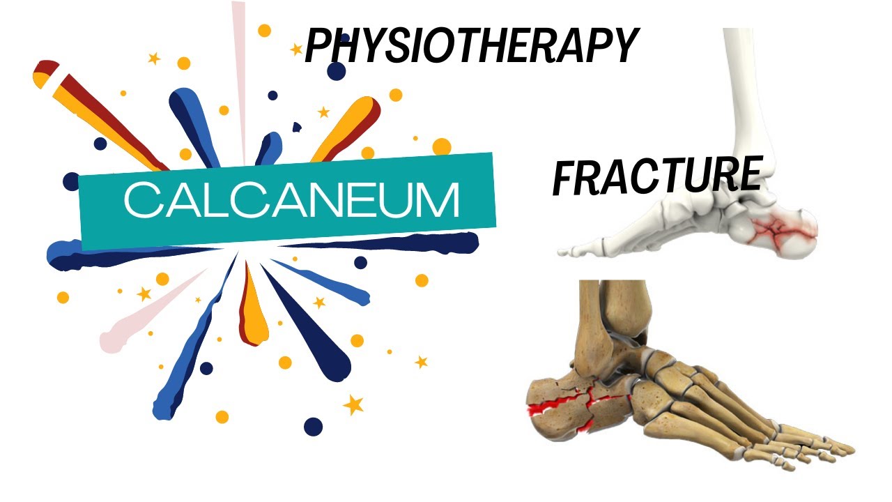 Calcaneum Fracture Rehabilitation|| Heel Fracture|| Dr. Rohit Rathore||Axon Physiotherapy