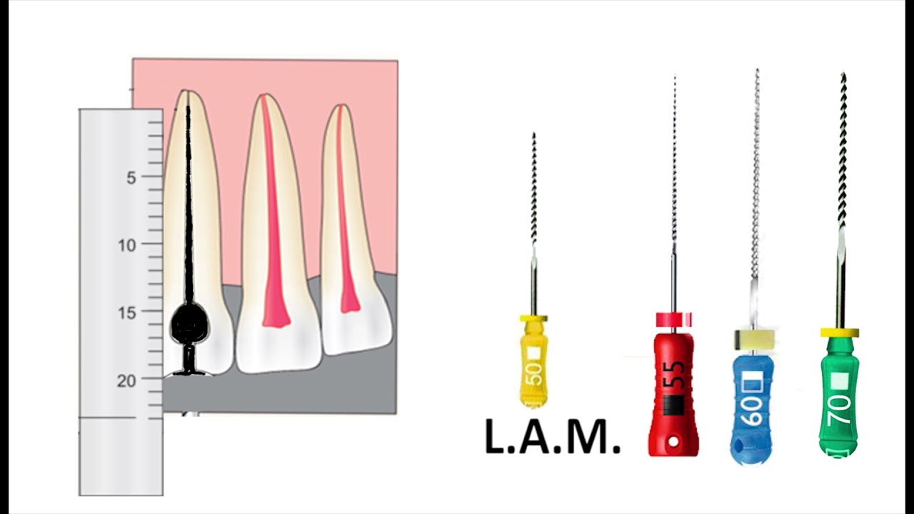 Instrumentación en endodoncia (técnica estandarizada con retroceso 